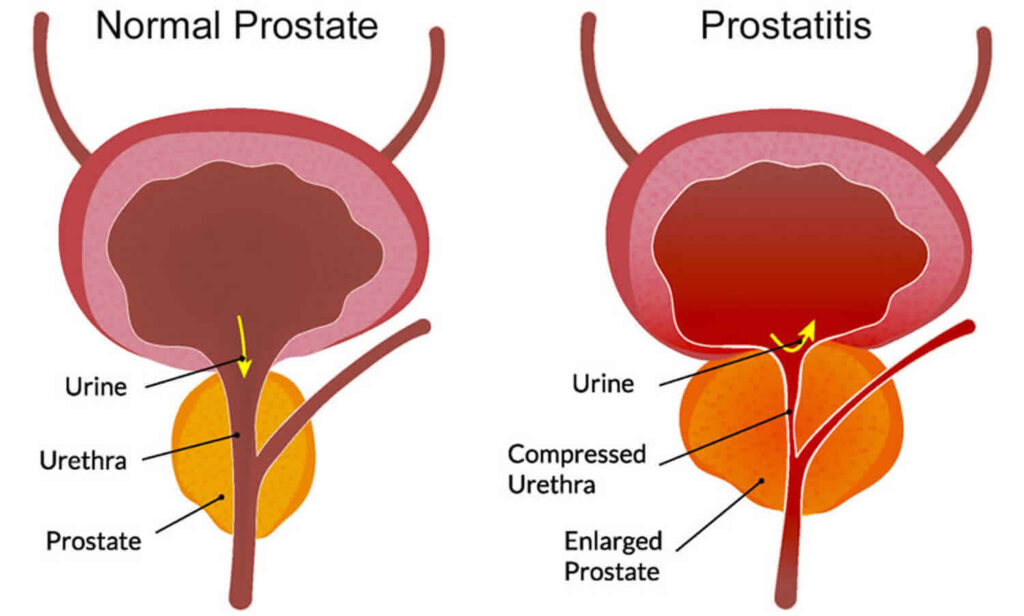 Pelvic Pain in Men Chronic Pelvic Pain Syndrome CPPS Treatment